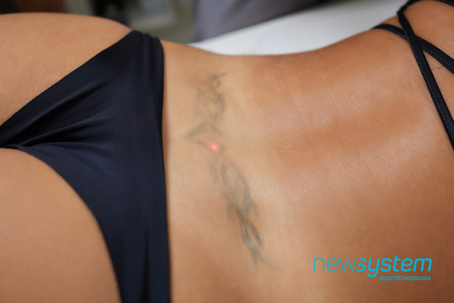 Eliminación de tatuajes con láser Nd Yag